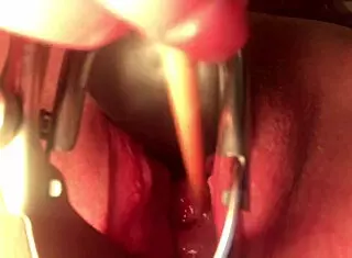 cervix insertion stretching procedure