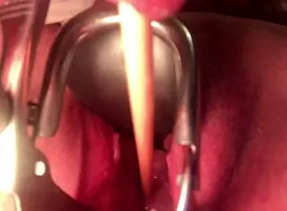 cervix insertion stretching procedure