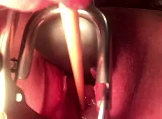 cervix insertion stretching procedure