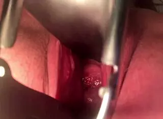 cervix insertion stretching procedure